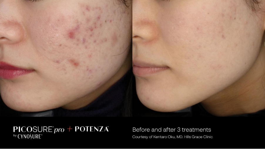 Discover CynoGlow, a powerful skin treatment combining PicoSure Pro and Potenza RF Microneedling to address multiple skin concerns effectively